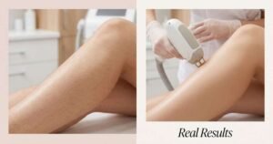 Full Brazilian Laser Hair Removal Before and After Photos